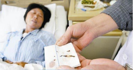 通過手術(shù)取出的針?！　∩虉?bào)記者 