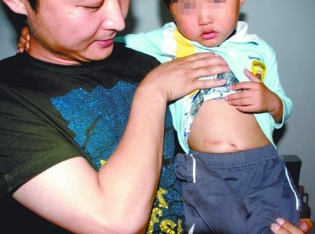 來(lái)一口果凍致男童腸梗阻 開(kāi)腸破肚取出一團(tuán)膠