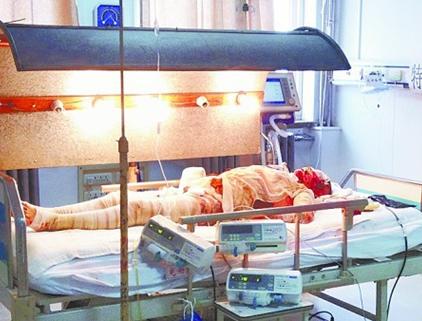 液化氣爆炸女子全身燒傷 感染超級細菌臉爛掉 液化氣爆炸女子全身燒傷 感染超級細菌臉爛掉