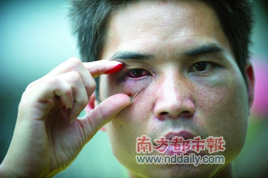 皮某身上多處被打傷。