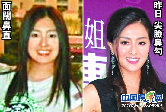 有人爆料指張名雅做過四次整形手術，還提供了一張疑似張名雅的舊照(左圖)