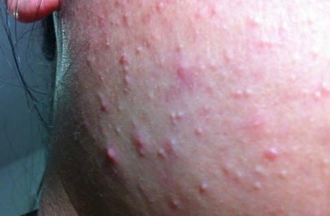 植秀堂3680元美容療程換來(lái)一臉痘 店家稱排毒