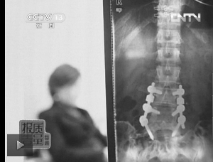 圖1：教練按壓導致學員腰椎間盤突出。（央視截屏）