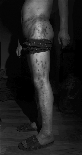 10月4日，湖北智障人士吳發(fā)兵腰部及腿部傷痕累累。他稱，8月8日，他被騙到洗車行工作，多次遭領班毆打。