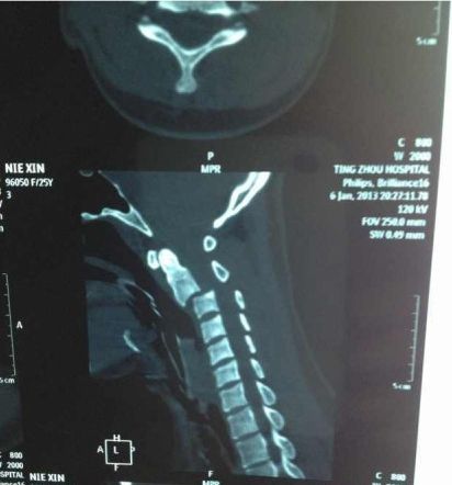 女演員聶鑫遇車禍受重傷恐成植物人 隨時有可能死亡