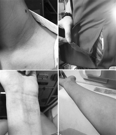 南航一空姐被打后，稱其手部淤青，身上有多處撓痕。